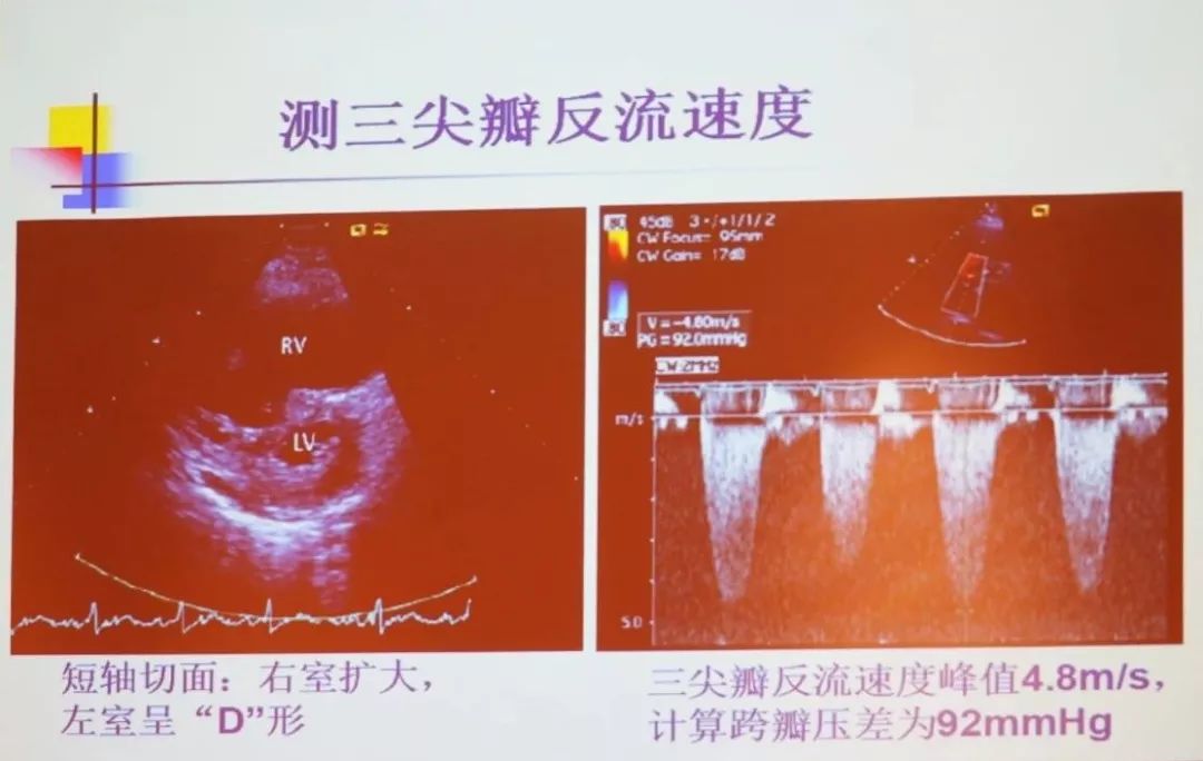 肺心病右心衰竭怎么办,肺心病心衰晚期如何治疗