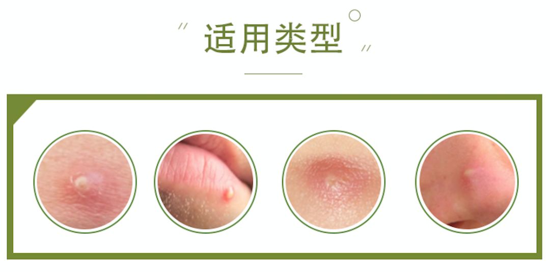 约会的前一天长了个痘,约会之前必长痘