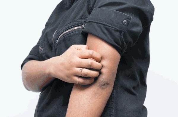 痒痒痒！6大原则解决秋季皮肤瘙痒。「内有视频」