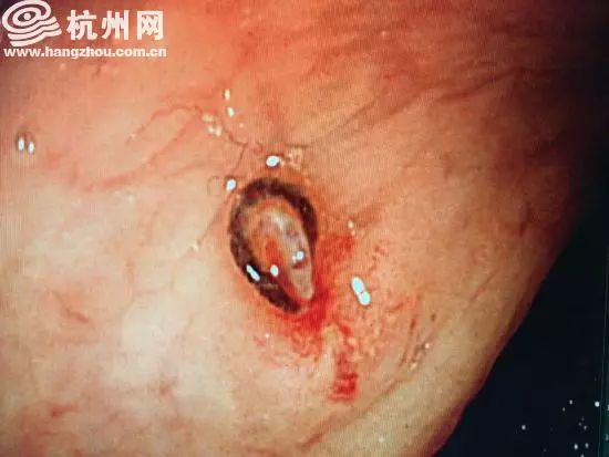 女子便血做肠镜,一女子长期便血