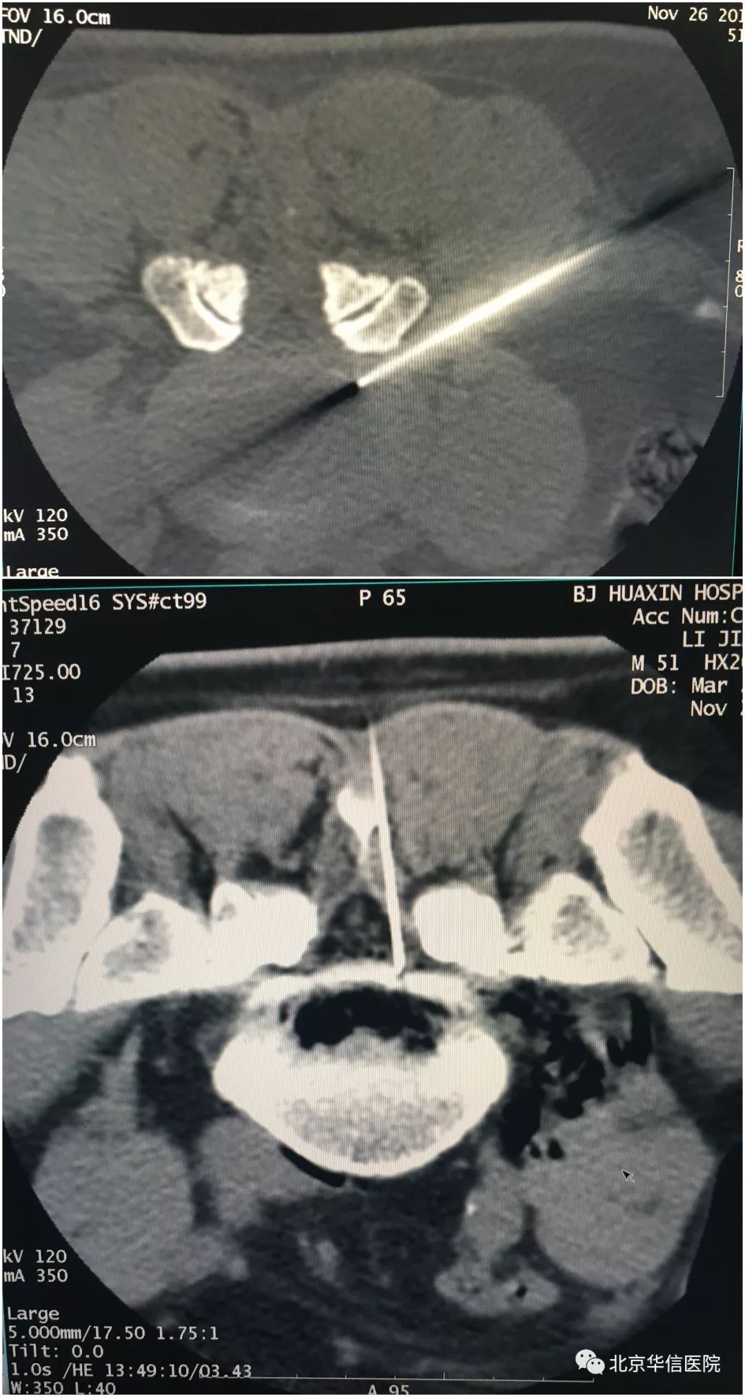 低温等离子微创消融术,北京华信医院麻醉