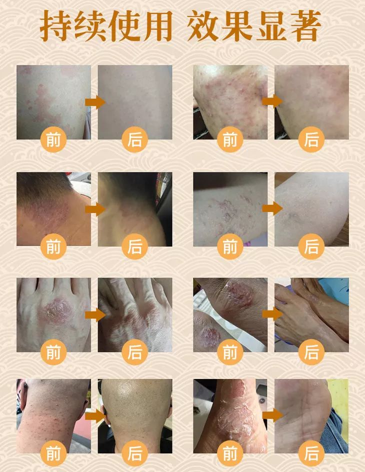 脚气湿疹止痒最快的软膏,湿疹止痒膏可以治脚气吗