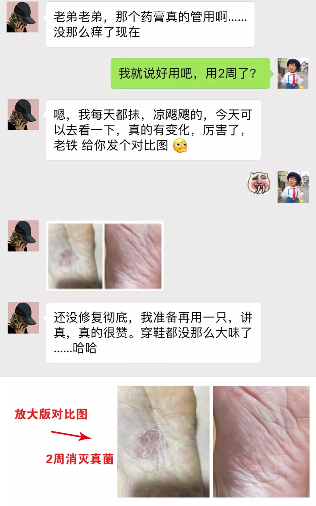 脚气湿疹止痒最快的软膏,湿疹止痒膏可以治脚气吗