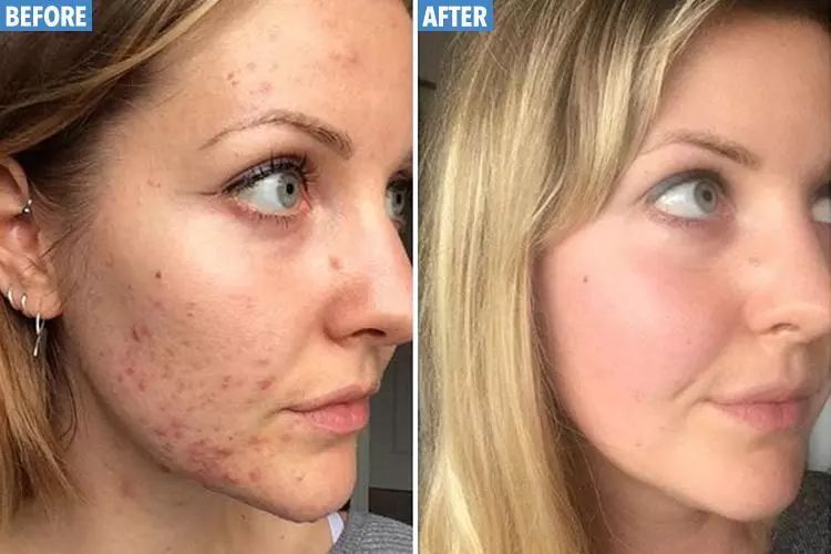 脚气湿疹止痒最快的软膏,湿疹止痒膏可以治脚气吗