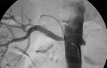 微创介入治疗肿瘤是什么科,介入治疗肿瘤副作用