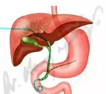 微创介入治疗肿瘤是什么科,介入治疗肿瘤副作用