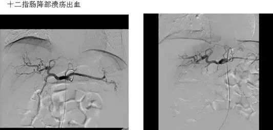 微创介入治疗肿瘤是什么科,介入治疗肿瘤副作用