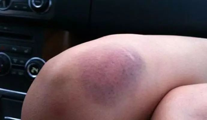 身体莫名出现淤青是癌症前兆吗,身体莫名其妙出现淤青是癌症吗