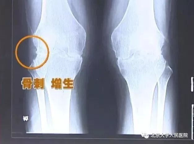 预告｜类风湿关节炎，预防控制至关重要！北京大学人民医院栗占国做客BTV《健康北京》