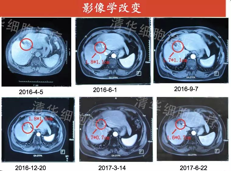 「肝胆管细胞癌，NKT治疗案例展示」清华NKT·乐和亲友2016-43