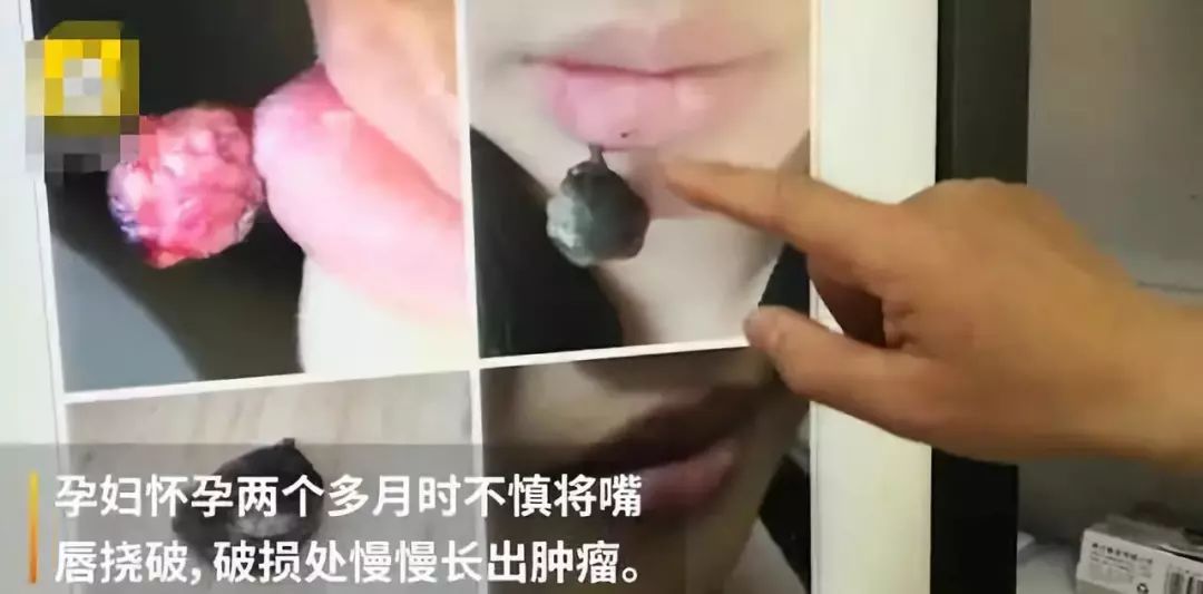 唇膜贴干唇救星,唇干裂用什么护唇