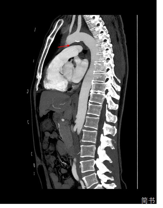 胸痛有时还会伴有响声,胸痛并伴有咽喉有异物感