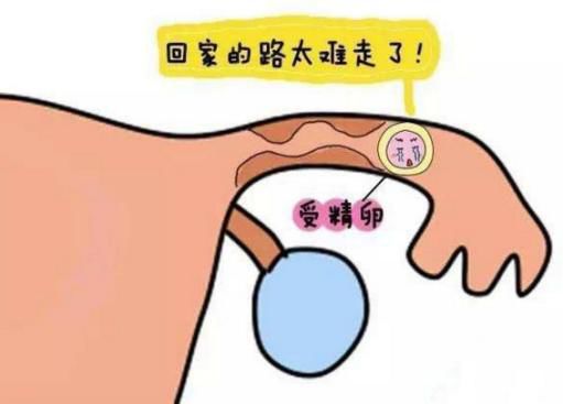 宫内孕合并宫外孕，医生护士协同作战降服病魔