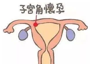 宫内孕合并宫外孕，医生护士协同作战降服病魔