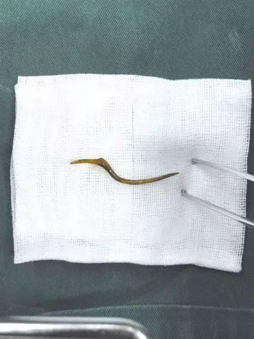 女子吃完火锅嗓子疼10分钟去医院,女子吃烧烤喉咙疼