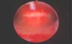 宫腔镜检查子宫靠左,宫腔镜检查止血效果好吧