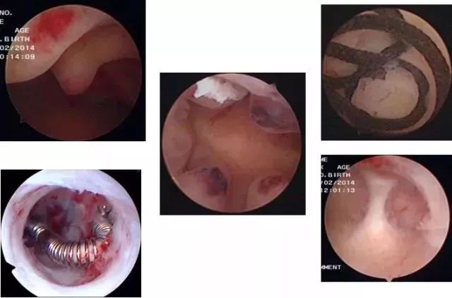 宫腔镜检查子宫靠左,宫腔镜检查止血效果好吧