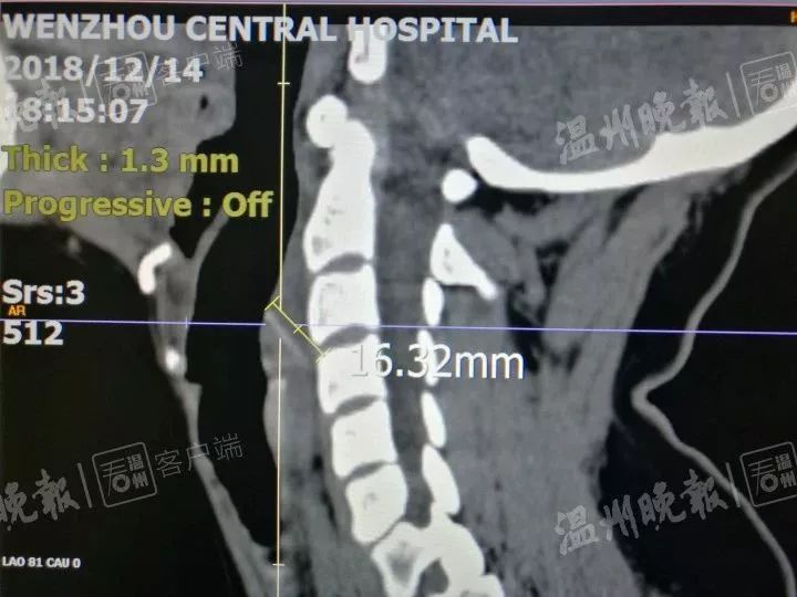 女子吃完火锅嗓子疼10分钟去医院,女子吃烧烤喉咙疼