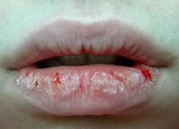 嘴唇起皮干裂能不能咬嘴唇,嘴唇起皮用手撕开了怎么办