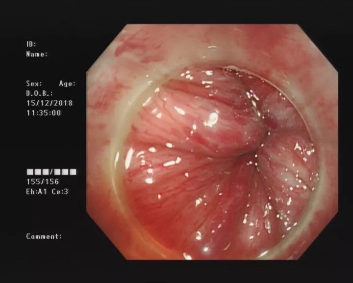 健康｜让你坐立不安的痔疮要这么治……