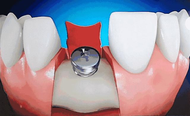 推广｜身份证42开头的关注！牙齿矫正、种植牙，这些全免费！