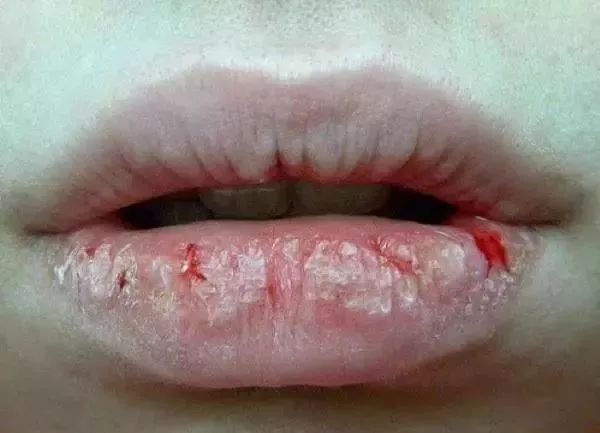 健康｜该如何改善嘴唇干燥起皮，是咬掉吗？