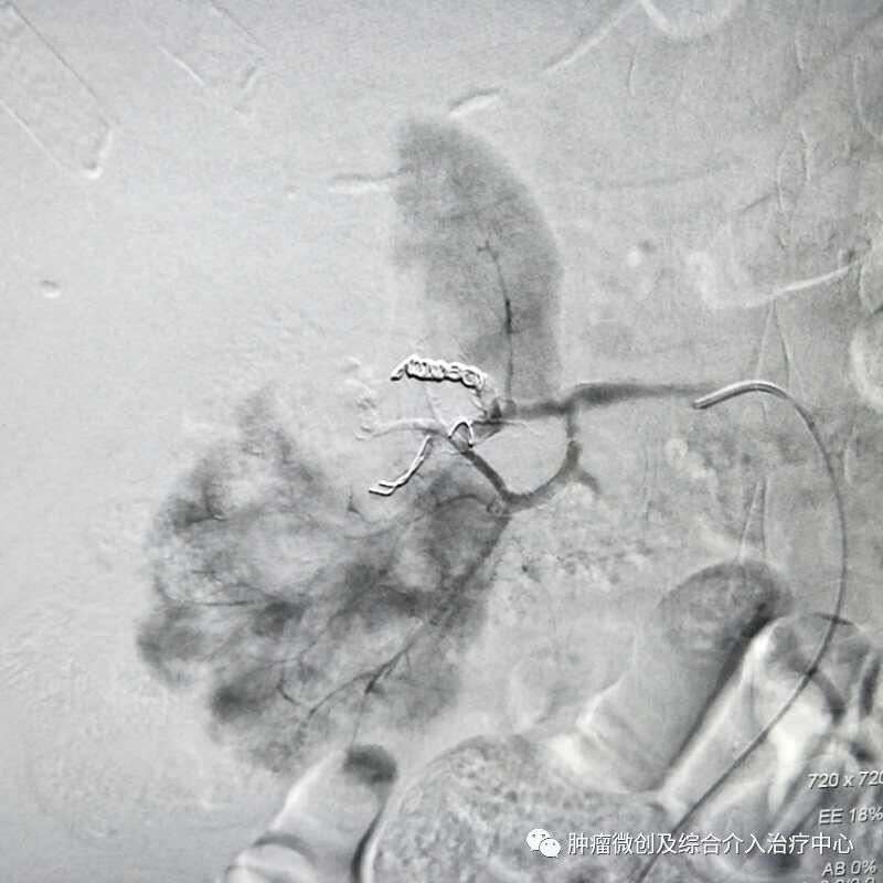 运城第一医院肿瘤介入科专家,运城市第一医院介入科专家