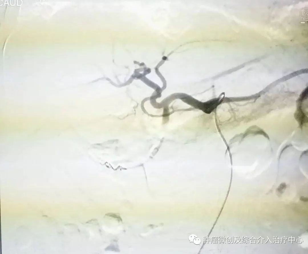 运城第一医院肿瘤介入科专家,运城市第一医院介入科专家