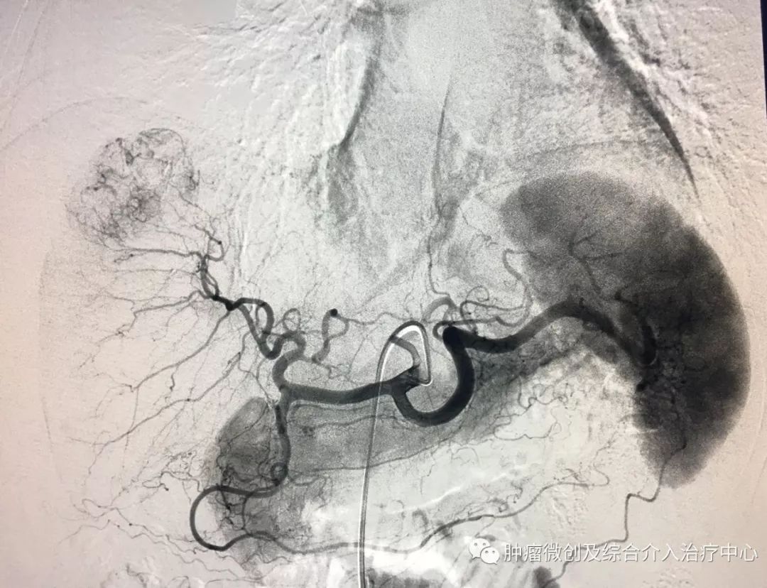 运城第一医院肿瘤介入科专家,运城市第一医院介入科专家