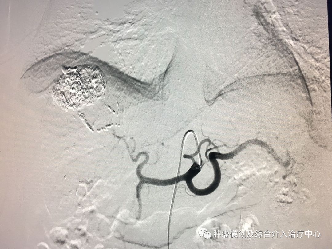 运城第一医院肿瘤介入科专家,运城市第一医院介入科专家