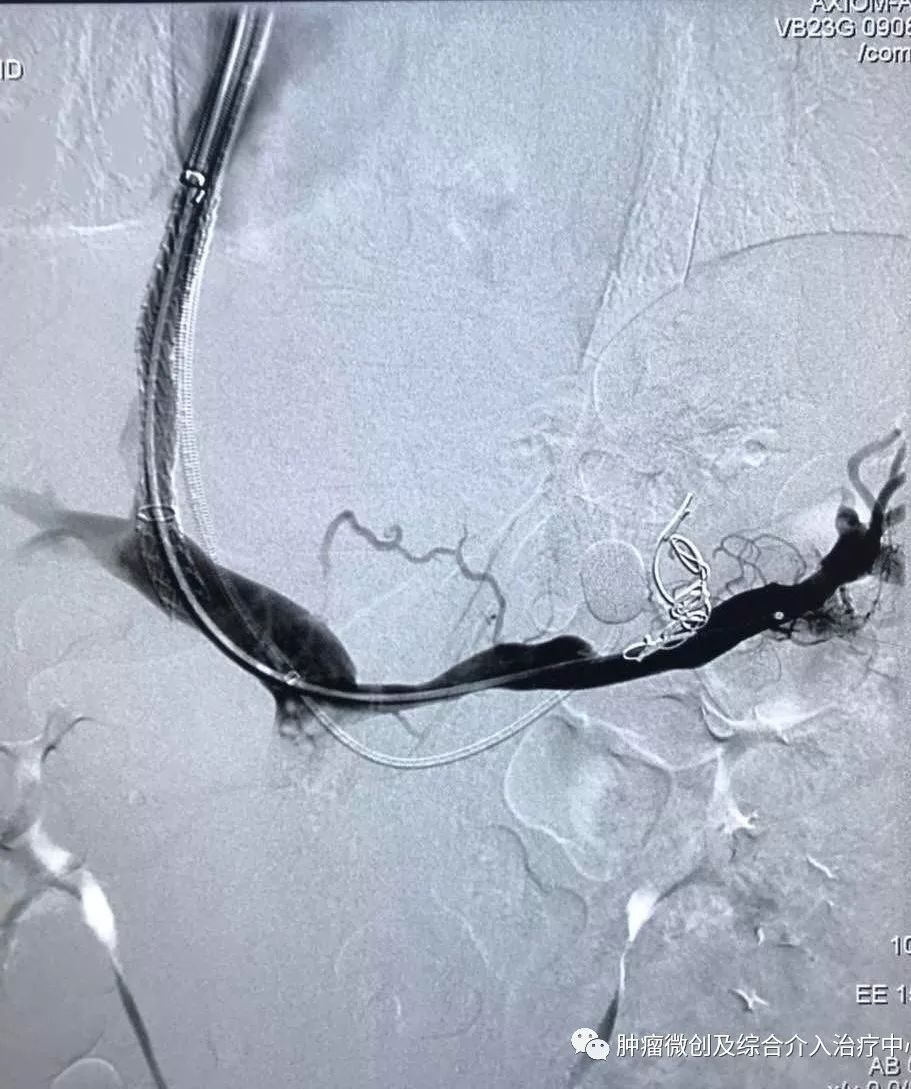 运城第一医院肿瘤介入科专家,运城市第一医院介入科专家