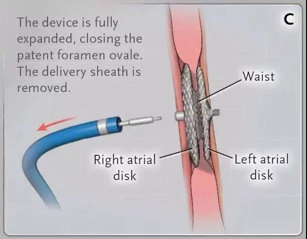卵圆孔封堵术后脑梗复发几率,卵圆孔未闭封堵能治头痛吗