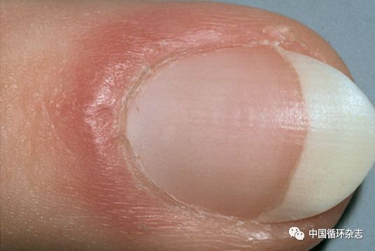 指甲代表肝功能吗,指甲病是肝不好吗