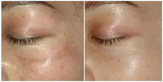 激光祛斑美容科普视频,激光美容有哪些优点和缺点