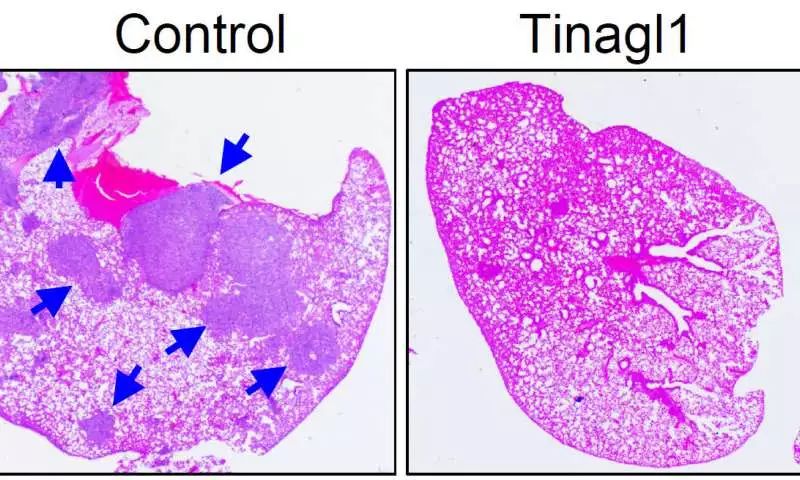 三阴乳腺癌适合双靶向治疗吗,三阴性乳腺癌晚期有存活10年的吗