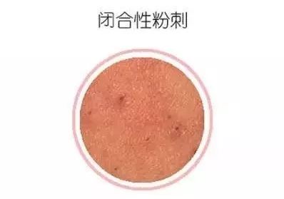 皮肤反复长闭口是什么原因,闭口痘痘反复长是什么原因