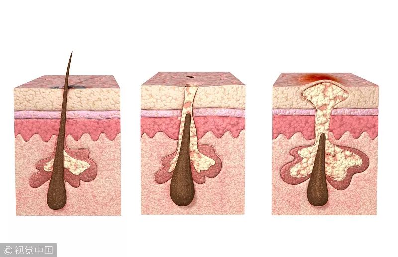 皮肤反复长闭口是什么原因,闭口痘痘反复长是什么原因