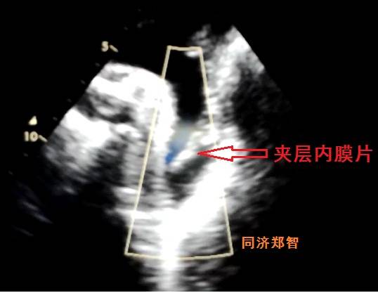 主动脉夹层cta能扫描出来吗,急性主动脉夹层cta影像诊断与鉴别