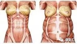 产后恢复腹直肌分离训练,产后康复腹直肌分离手法