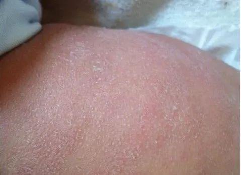 一岁半宝宝脚底皱皱巴巴的,一岁宝宝皮肤粗糙像鸡皮瘙痒