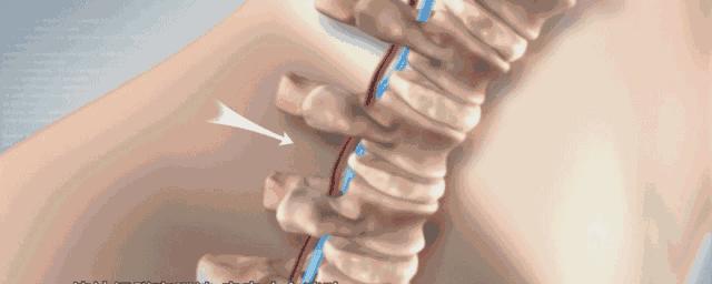 治疗肩颈痛的神器,好的缓解肩颈疼痛产品