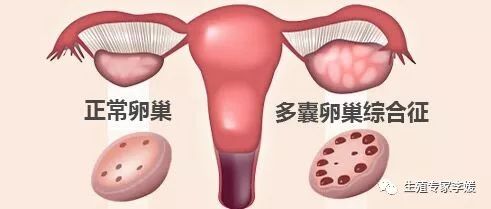 通经汤治疗闭经,闭经的中医治疗