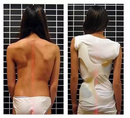 父母必看系列青少年心理健康,家长发现脊柱侧弯