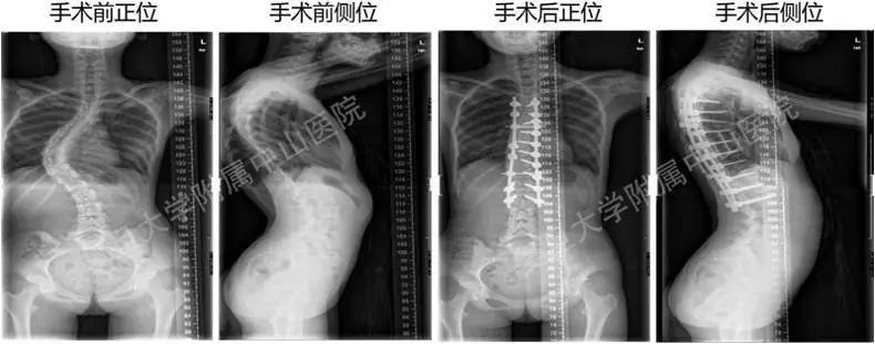父母必看系列青少年心理健康,家长发现脊柱侧弯