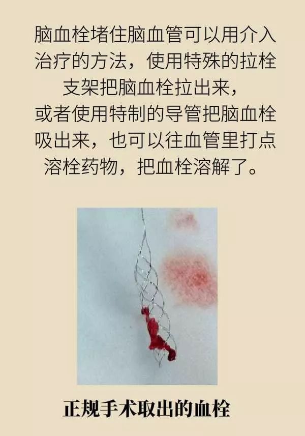 微针取血栓骗局视频,微针取血栓是国家认可吗