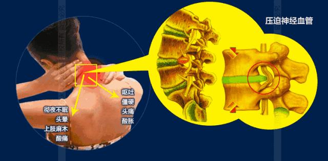 脖子酸肩颈痛按按这3处轻松缓解,肩酸脖子痛用什么姿势缓解