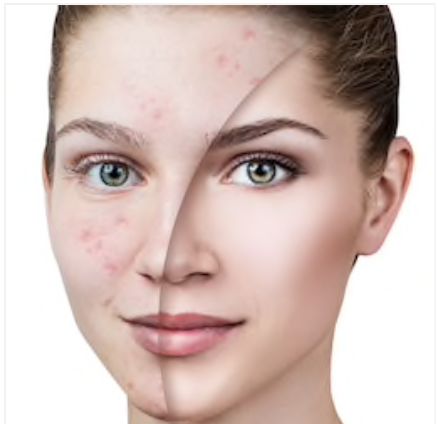 痘痘怎么才能不反复长痘,怎么快速祛除上火长的痘痘