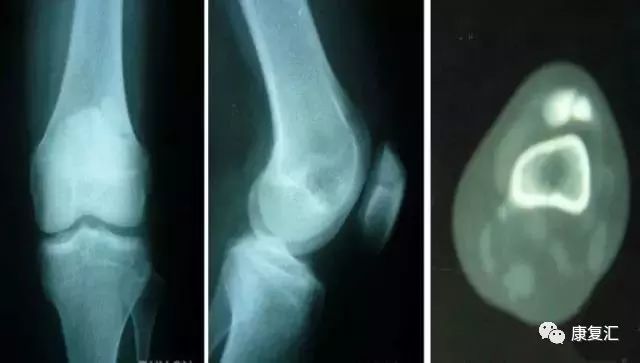 膝关节不同部位疼痛的病因分析,膝关节疼痛的十大原因及治疗