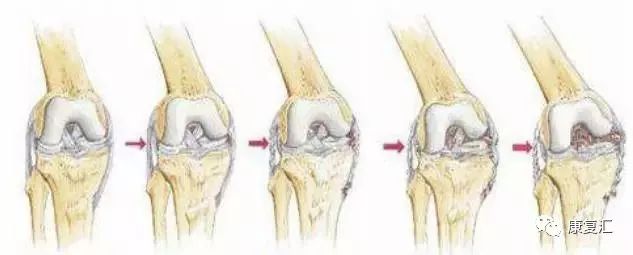膝关节不同部位疼痛的病因分析,膝关节疼痛的十大原因及治疗