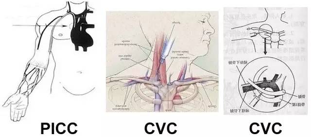 基护｜静脉导管堵塞？如何防堵管？